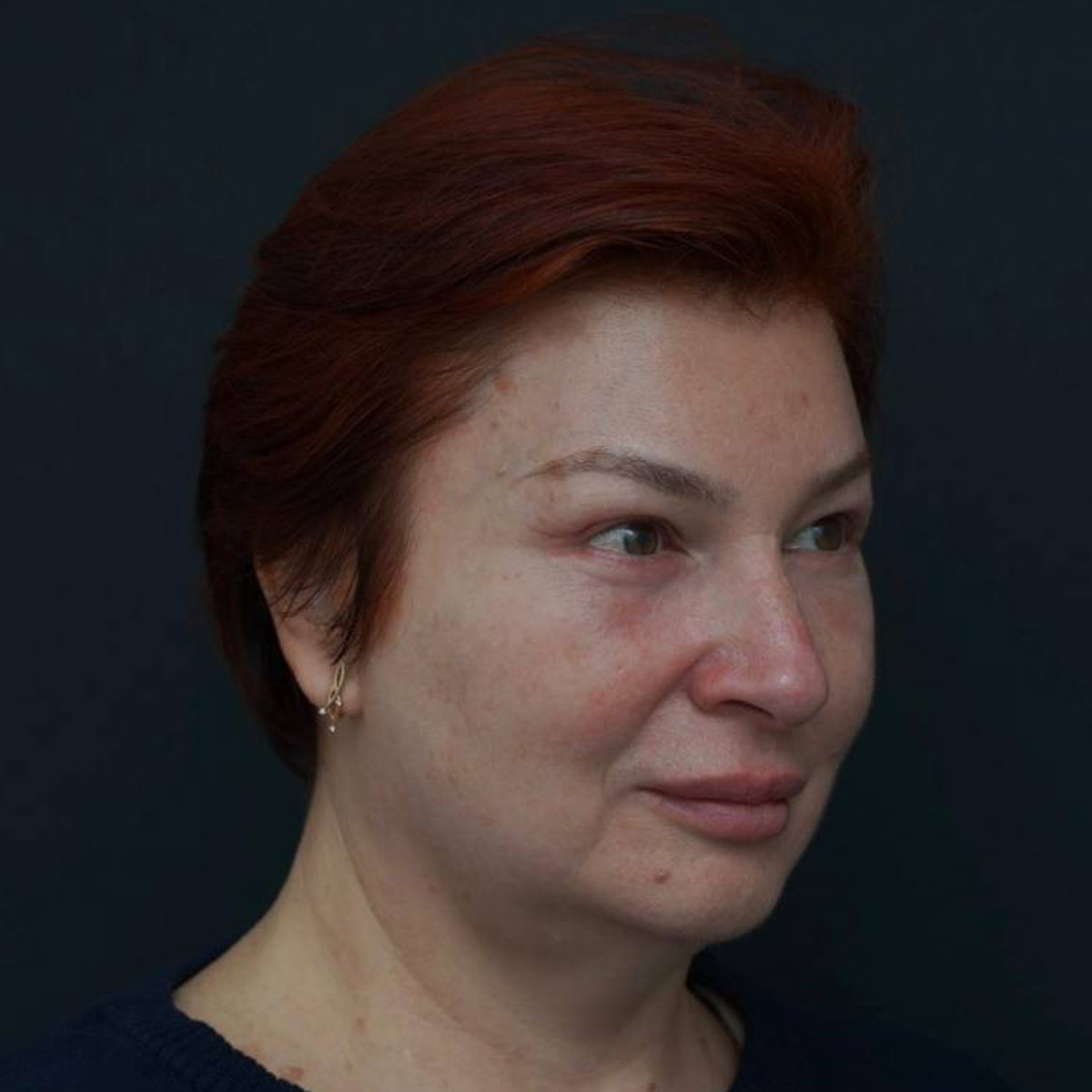 Блефаропластика